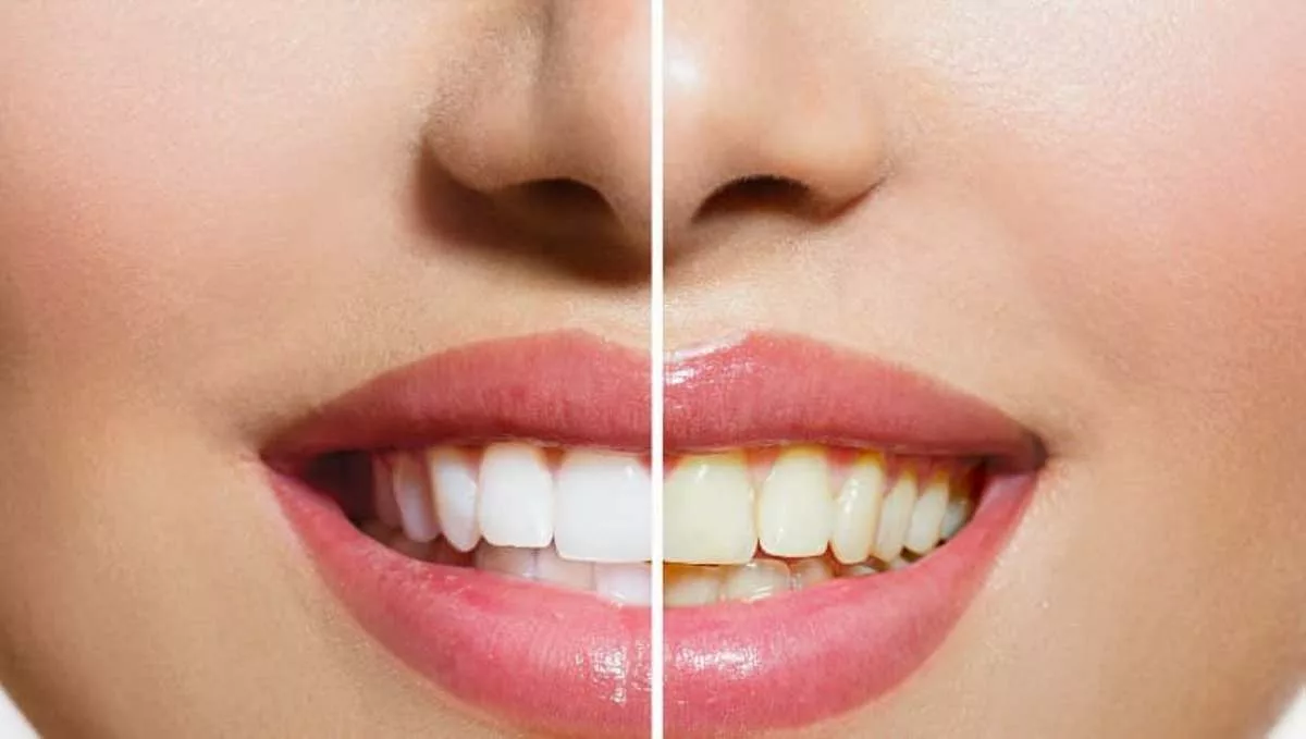 Try These Effective Home Remedies To Whiten Yellow Teeth