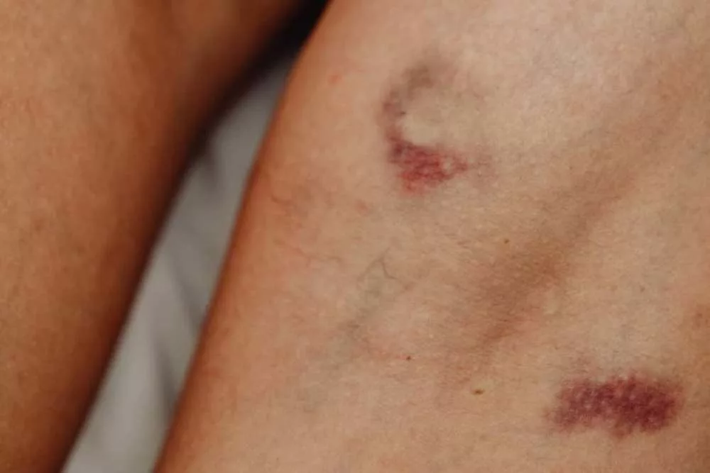 Do You Always Have Inexplicable Bruises? This Might Be Why