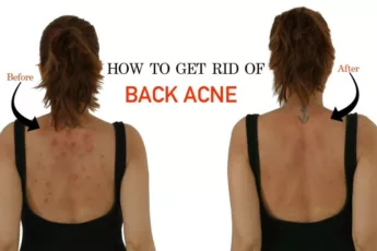 Tired Of Back Acne? Here's How To Get Rid Of It Naturally