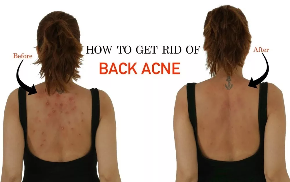 Tired Of Back Acne? Here's How To Get Rid Of It Naturally