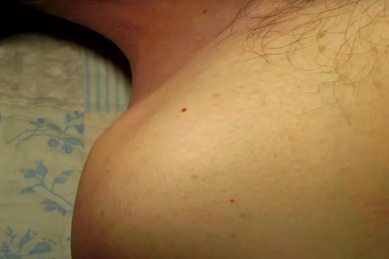 Dermatologists: This Is How Those Red ‘moles’ Can Be Removed