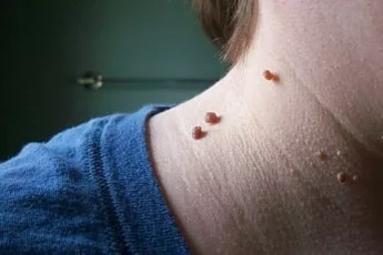 There’s An Easy And Painless Way To Get Rid Of Skin Tags! It Isn’t Scary At All!