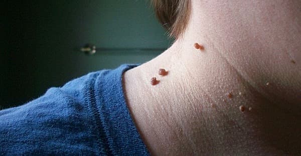 There’s An Easy And Painless Way To Get Rid Of Skin Tags! It Isn’t Scary At All!