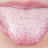 THIS Is What A White Tongue Says About Your Health! Very Few People Know This!