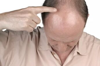 Frontal Hair Loss: Causes And How To Treat It