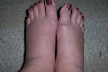 She Retained A Lot Of Water In Her Feet But That Disappeared After Following These 6 Tricks!