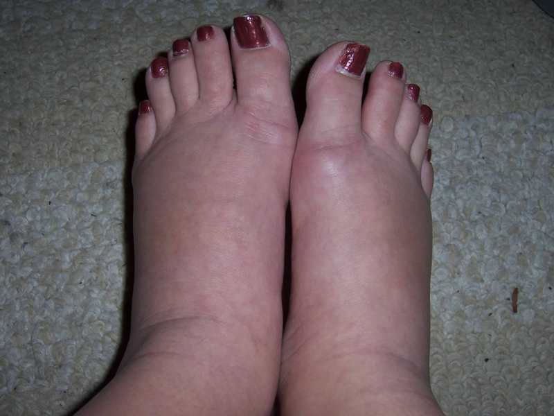 She Retained A Lot Of Water In Her Feet But That Disappeared After Following These 6 Tricks!