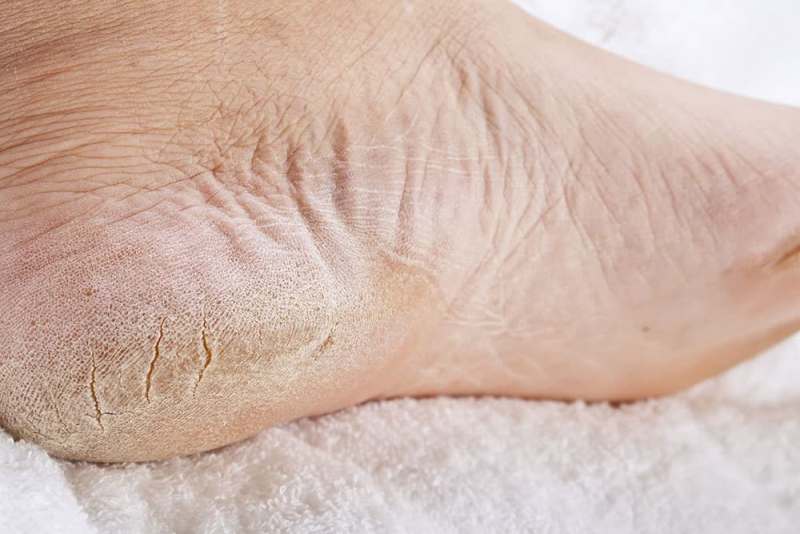 Annoying And Painful: Heel Fissures! This Natural Remedy Brings Instant Relief