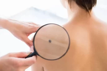 Remove Skin Tags At Home: A Simple Guide To Skin Tags Removal