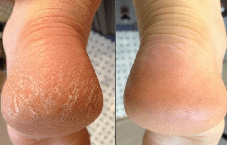 This Cheap Product You’ve Already Got In Your Kitchen Cupboard Can Help Reduce Cracked Heels