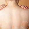 Tiny Red Spots Appearing On Your Body Could Be Cherry Angiomas