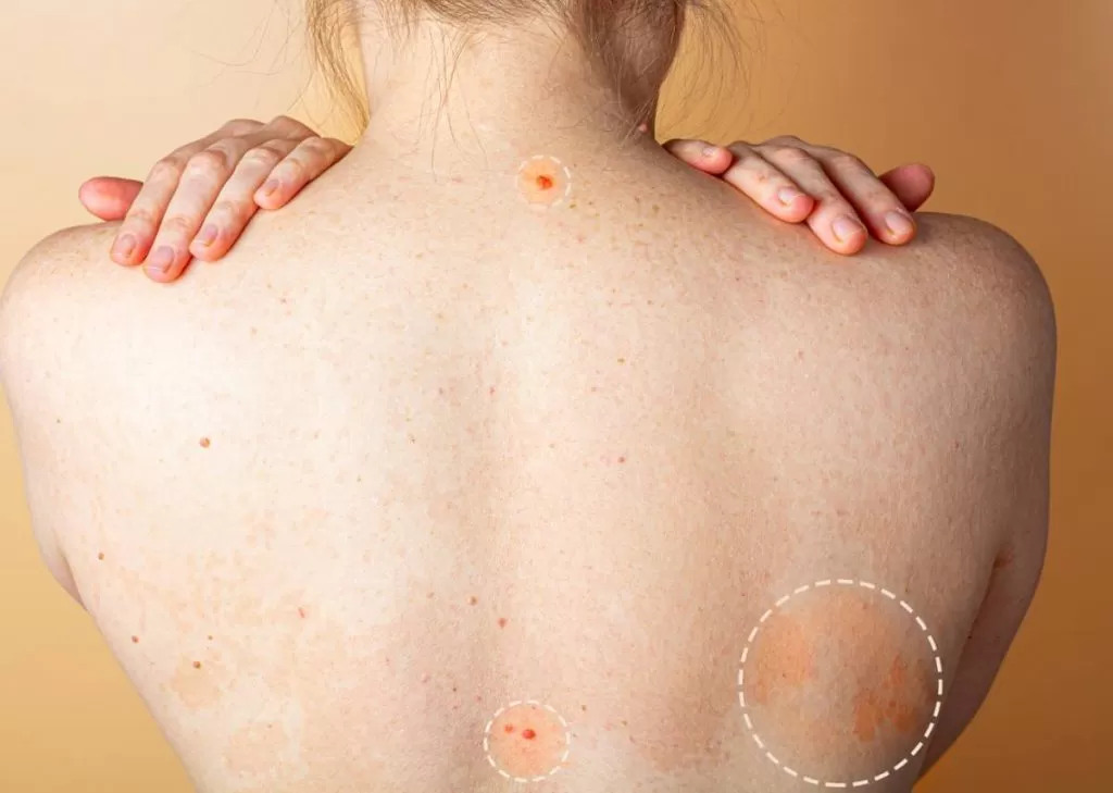 Tiny Red Spots Appearing On Your Body Could Be Cherry Angiomas